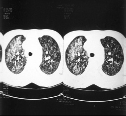 CT plic – plicní infiltráty při leukostáze 