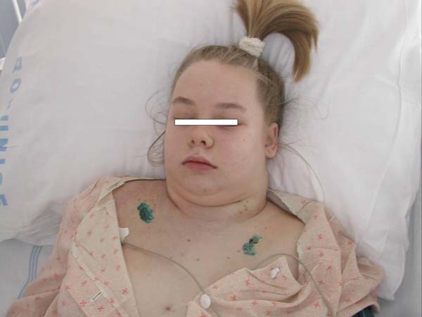 Dívka se známkami syndromu HDŽ na podkladě Non-hodgkinského lymfomu mediastina