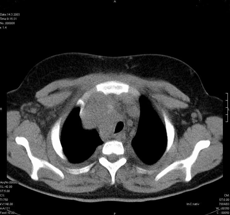 CT obraz hrudníku: patologicky zvětšené a infiltrované uzliny středního a předního mediastina lymfomem, útlak průdušnice, výpotek v pohrudniční dutině