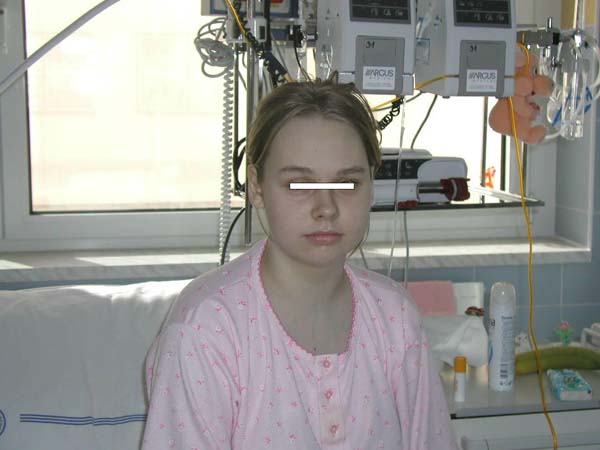 Dívka z obr. 16 po úspěšné terapii syndromu HDŽ