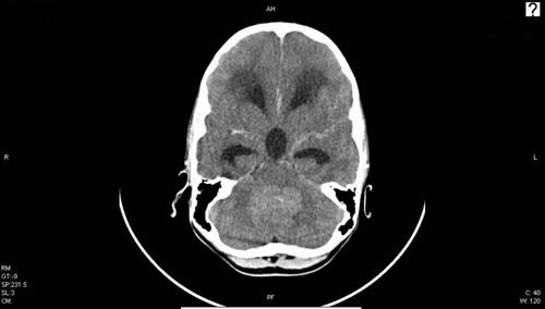 CT mozku - solidní nádor v zadní jámě (meduloblastom) působící hydrocefalus