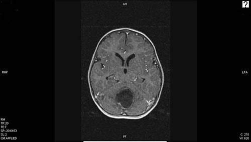 MRI mozku - cystický nádor v zadní jámě (pilocytický astrocytom)