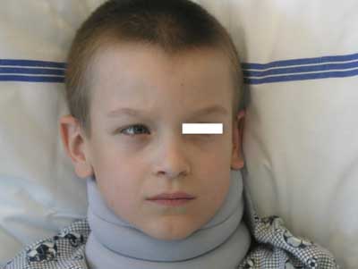 Strabismus (šilhání) u chlapce s meduloblastomem mozečku a SIKH