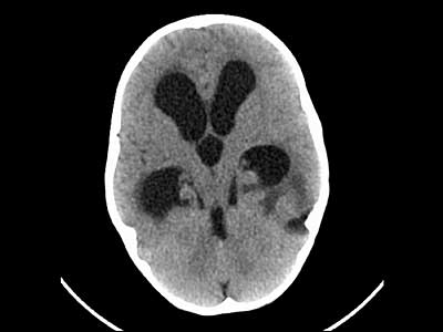 CT mozku - rozšíření komor, známky přestupu moku do mozkové tkáně až otok mozku