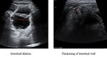 Figure  3: Ultrasound of intestine and NEC