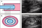 Figure 10: Intussusception as a cause of ileus on ultrasound (Abrahams RB, J Med Cases 2012)