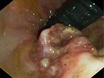 Figure 7: Endoscopy of adenocarcinoma of the colon