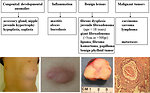 Figure 14: The most common breast pathology in adolescent girls