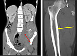 Figure 8: Ewing sarcoma CT scan