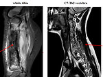 Figure 9: Ewing sarcoma MRI