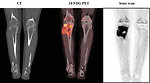 Figure 11: CT, PET and bones scan of Ewing sarcoma