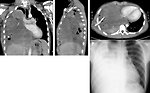 Figure 9: Mediastinal germ cell tumor in 16-year-old boy (KDO FN Brno)