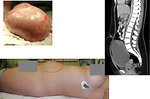 Figure 10: Ovarian germ cell tumor (KDO FN Brno)