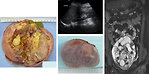 Figure 11: Mature teratoma of the ovary (KDO FN Brno)