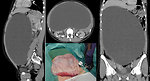 Figure 16: CT of the ovarian cyst permagnum (KDO FN Brno)