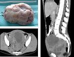 Figure 17: CT of the ovarian germ cell tumor (KDO FN Brno)