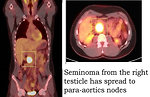 Figure 18: Retroperitoneal lymph nodes involvement of testicular germ cell tumor on 18 FDG PET scan (KDO FN Brno)
