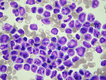 Figure 1: Peripheral blood wih hyperleukocytosis (T-ALL)