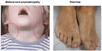 Figure 3. Clinical presentation of ALL