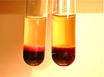 Figure 4: Peripheral blood sample with excessive number of leukemic blasts (T-ALL) compare with normal blood