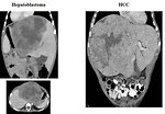 Figure 9: CT scan of liver tumors