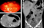 Figure 15: Multiple nodules of hepatocellular carcinoma