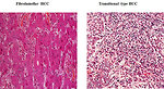 Figure 16: Subtypes of hepatocellular carcinoma