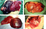 Figure 21: Pediatric liver tumors before radical surgery
