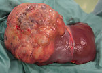 Figure 23: Liver transplantation for pediatric hepatocellular carcinoma