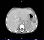 Figure 2: Abdominal CT scan, neuroblastic tumor of the left adrenal gland