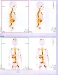 Figure 3: I-123 MIBG scans of a patient with multiple bone metastases of the spine, sternum, skull, long bones of the upper and lower extremities. The primary tumor is in the right adrenal gland.