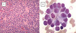 Figure 4: Neuroblastoma. (A) typical “small blue round cell tumor” of a childhood, (B) rossetes of neuroblastic cells