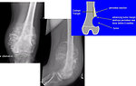 Figure 6: Plain X-ray of osteosarcoma