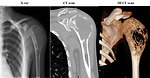 Figure 8: Imaging studies of osteosarcoma of the left proximal humerus