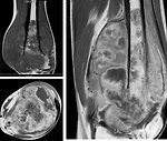 Figure 9: MRI osteosarcoma of the left distal femur