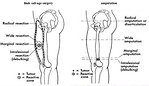 Figure 14: Surgery in osteosarcoma