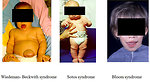 Figure 6: Genetic predisposition syndromes associated with Wilms tumor