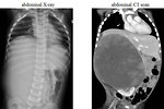 Figure 11: X-ray and CT of Wilms tumor