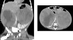 Figure 12: Bilateral Wilms tumor