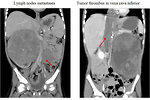 Figure 13: CT scan if metastatic Wilms tumor
