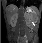 Figure 14: MRI of Wilms tumor