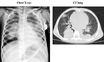 Figure 15: Lung metastases of Wilms tumor