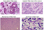 Figure 16: Pathology – types of WT