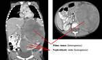 Figure 20: CT scan – Wilms tumor arising from perilobar nephroblastomatosis