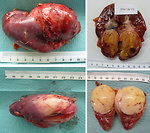Figure 23: Wilms tumor after nephrectomy
