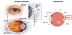 Figure 1: Anatomy of the eye and retinoblastoma (www.medscape.com)