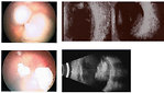 Figure 5: Ophthalmoscopy and ocular ultrasound (Morley J, www.wikimedia.org, 2008)