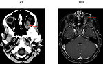Figure 6: CT and MRI of retinoblastoma (KDO FN Brno)