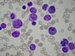 Myeloid and monocytic blast cells, on the right side 3 immature eosinophiles. 
Note large basophilic granules in adition to eosinophilic ones in cells seen on the right.. / Na obrzku myeloidn a monocytoidn blastick bb. V prav polovin 3 mlad Eo, vpravo nahoe a vpravo dole bb., kter maj krom eosinofilnch i velk basofiln granula.
