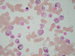 Myeloperoxidase reaction (MPOX). All cells , except nucleated RBCs are positive. / Barven na myeloperoxidzu (MPOX). Krom jedernch ervench krvinek jsou vechny bb. na snmku pozitivn.